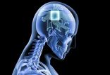 ایمپلنت مغزی,اخبار پزشکی,خبرهای پزشکی,تازه های پزشکی