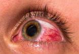 قرمزی چشم,اخبار پزشکی,خبرهای پزشکی,مشاوره پزشکی
