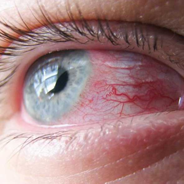 التهاب قرنیه,اخبار پزشکی,خبرهای پزشکی,مشاوره پزشکی