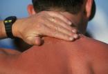 آفتاب زدگی,اخبار پزشکی,خبرهای پزشکی,مشاوره پزشکی