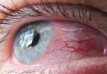 التهاب قرنیه,اخبار پزشکی,خبرهای پزشکی,مشاوره پزشکی