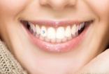 نصب نگین به روی دندان‌ها,اخبار پزشکی,خبرهای پزشکی,مشاوره پزشکی