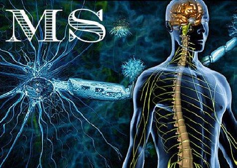 اماس اماس,اخبار پزشکی,خبرهای پزشکی,تازه های پزشکی