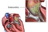 آندوکاردیت‌,اخبار پزشکی,خبرهای پزشکی,مشاوره پزشکی