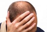 ریزش مو,اخبار پزشکی,خبرهای پزشکی,تازه های پزشکی