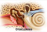 اتواسکلروز,اخبار پزشکی,خبرهای پزشکی,مشاوره پزشکی