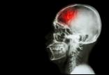 سکته مغزی,اخبار پزشکی,خبرهای پزشکی,تازه های پزشکی
