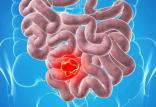 سرطان روده بزرگ,اخبار پزشکی,خبرهای پزشکی,تازه های پزشکی