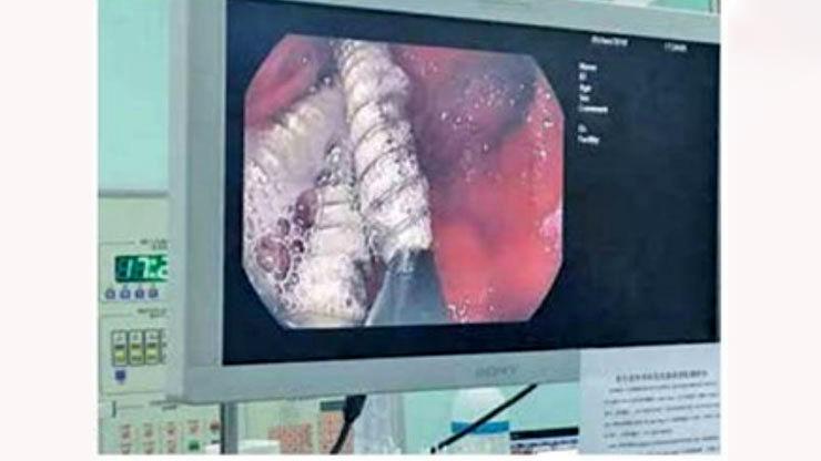 پیچ آهنی در معده نوزاد پیچ آهنی در معده نوزاد,اخبار حوادث,خبرهای حوادث,حوادث امروز