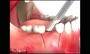 ویدئو مراحل کاشت و ایمپلنت دندان