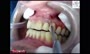 ویدئو/آبسه دندان و روش خارج کردن آن