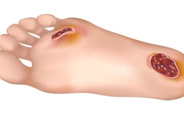 دیابت دیابت,اخبار پزشکی,خبرهای پزشکی,تازه های پزشکی