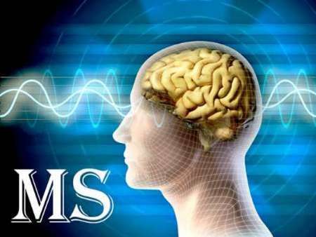 بیماری ام اس,اخبار پزشکی,خبرهای پزشکی,تازه های پزشکی