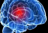 تومور مغزی,اخبار پزشکی,خبرهای پزشکی,تازه های پزشکی
