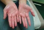 تعریق دست,اخبار پزشکی,خبرهای پزشکی,مشاوره پزشکی