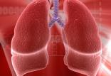 بیماری انسداد ریه,اخبار پزشکی,خبرهای پزشکی,مشاوره پزشکی