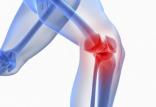 آسیب زانو,اخبار پزشکی,خبرهای پزشکی,مشاوره پزشکی