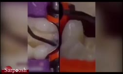 ویدئو/نحوه پر کردن دندان