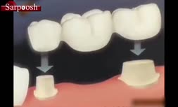 ویدئو/بریج دندان چیست و چگونه انجام می شود؟