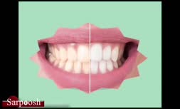 ویدئو/روش‌هایی برای جرم گیری دندان در خانه
