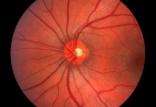 شبکیه چشم,اخبار پزشکی,خبرهای پزشکی,تازه های پزشکی