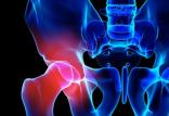 تغییر شکل استخوان لگن,اخبار پزشکی,خبرهای پزشکی,تازه های پزشکی