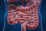 بیماری التهاب روده,اخبار پزشکی,خبرهای پزشکی,تازه های پزشکی