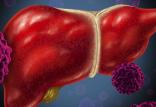 تاثیرمصرف الکل بر کبد,اخبار پزشکی,خبرهای پزشکی,مشاوره پزشکی