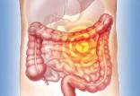 بیماران التهاب روده,اخبار پزشکی,خبرهای پزشکی,مشاوره پزشکی