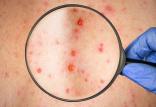 بیماری سرخک,اخبار پزشکی,خبرهای پزشکی,بهداشت
