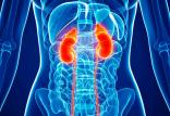 سنگ کلیه,اخبار پزشکی,خبرهای پزشکی,مشاوره پزشکی