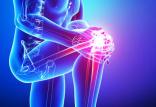 آرتروز زانو,اخبار پزشکی,خبرهای پزشکی,مشاوره پزشکی