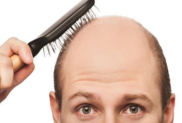 ریزش مو ریزش مو,اخبار پزشکی,خبرهای پزشکی,تازه های پزشکی