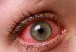 آلرژی های چشمی,اخبار پزشکی,خبرهای پزشکی,مشاوره پزشکی