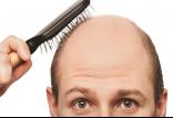 ریزش مو,اخبار پزشکی,خبرهای پزشکی,تازه های پزشکی