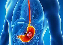 سرطان گوارش,اخبار پزشکی,خبرهای پزشکی,بهداشت