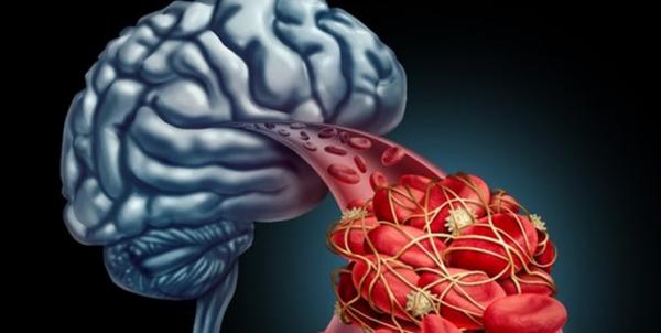 درمان آلزایمر درمان آلزایمر,اخبار پزشکی,خبرهای پزشکی,تازه های پزشکی