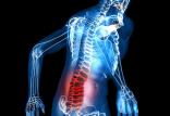 درد سیاتیک,اخبار پزشکی,خبرهای پزشکی,تازه های پزشکی