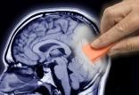درمان آلزایمر,اخبار پزشکی,خبرهای پزشکی,تازه های پزشکی