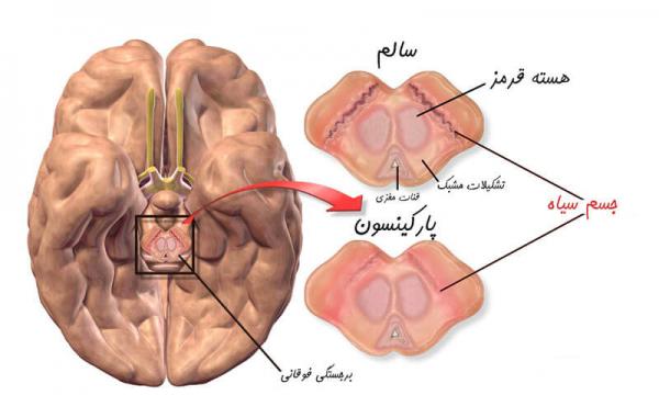 بیماری پارکینسون,اخبار پزشکی,خبرهای پزشکی,تازه های پزشکی