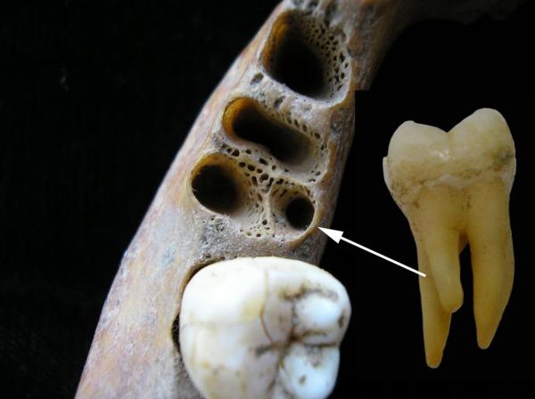 دندان آسیای باستانی با سه ریشه,اخبار جالب,خبرهای جالب,خواندنی ها و دیدنی ها