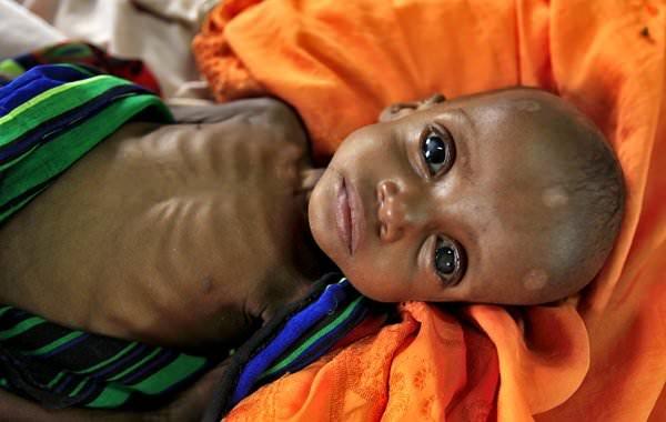 سوء تغذیه کودکان در شاخ آفریقا,اخبار پزشکی,خبرهای پزشکی,بهداشت