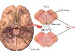 بیماری پارکینسون,اخبار پزشکی,خبرهای پزشکی,تازه های پزشکی