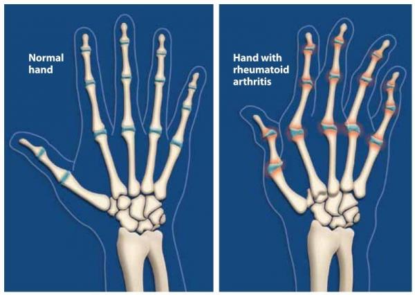 بیماری روماتیسم مفصلی بیماری روماتیسم مفصلی,اخبار پزشکی,خبرهای پزشکی,تازه های پزشکی
