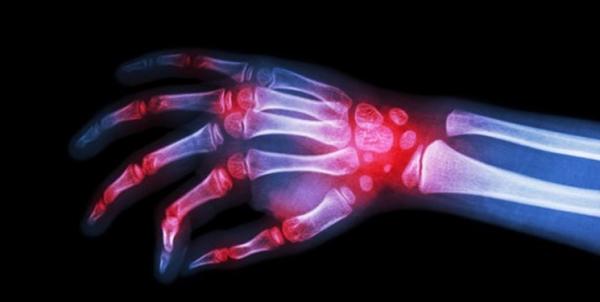 بیماری روماتیسم مفصلی بیماری روماتیسم مفصلی,اخبار پزشکی,خبرهای پزشکی,تازه های پزشکی