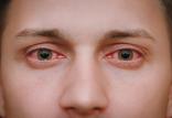 عفونت چشمی خطرناک,اخبار پزشکی,خبرهای پزشکی,مشاوره پزشکی