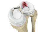 پارگی مینیسک زانو,اخبار پزشکی,خبرهای پزشکی,مشاوره پزشکی