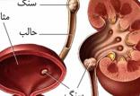 سنگ مثانه,اخبار پزشکی,خبرهای پزشکی,مشاوره پزشکی