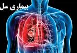 بیماری سل,اخبار پزشکی,خبرهای پزشکی,بهداشت