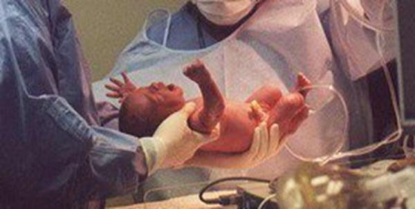 تولد نوزادان از طریق سزارین,اخبار پزشکی,خبرهای پزشکی,تازه های پزشکی
